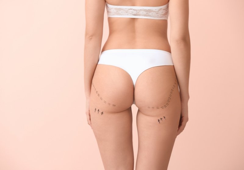 Gluteoplastía con Implantes en Bolivia - Dr. Nadir Salaues
