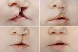 Labioschisi e palatoschisi si verifica quando un bambino nasce con una fessura nel labbro superiore e/o nel palato