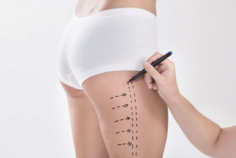 Read more about the article Lifting de piernas, the solution to flaccidity that is in trend